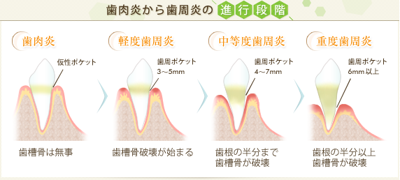 歯肉炎から歯周炎の進行段階